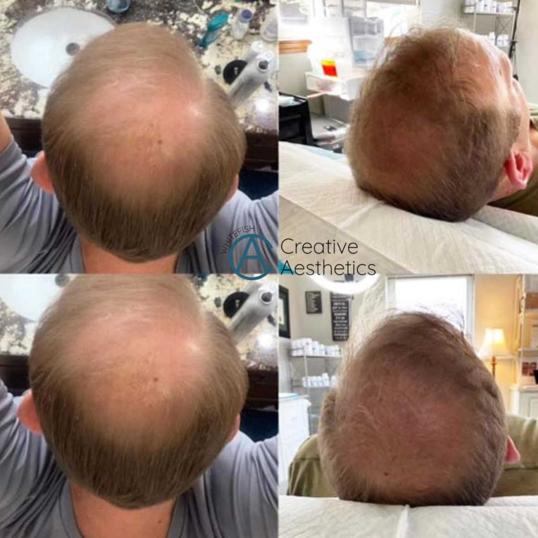 before and after PRF hair loss restoration