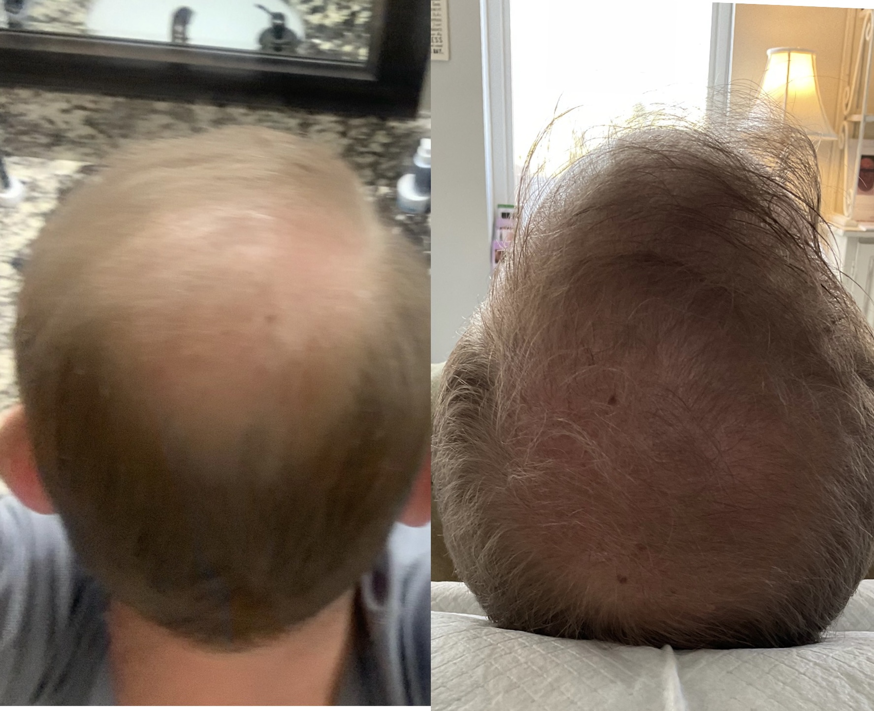 prf-hair-restoration.png