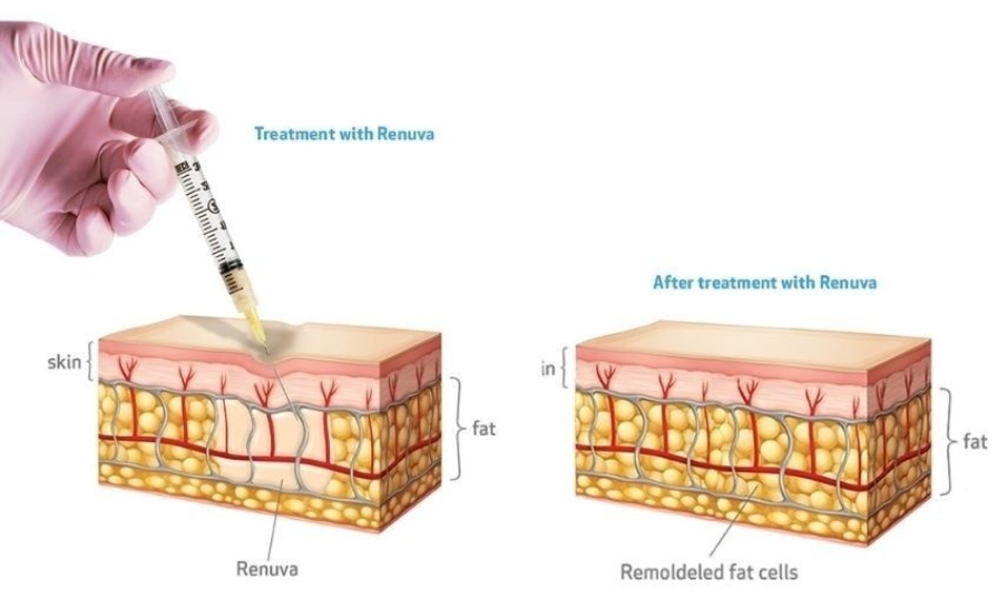 renuva ss2 renuva ss2